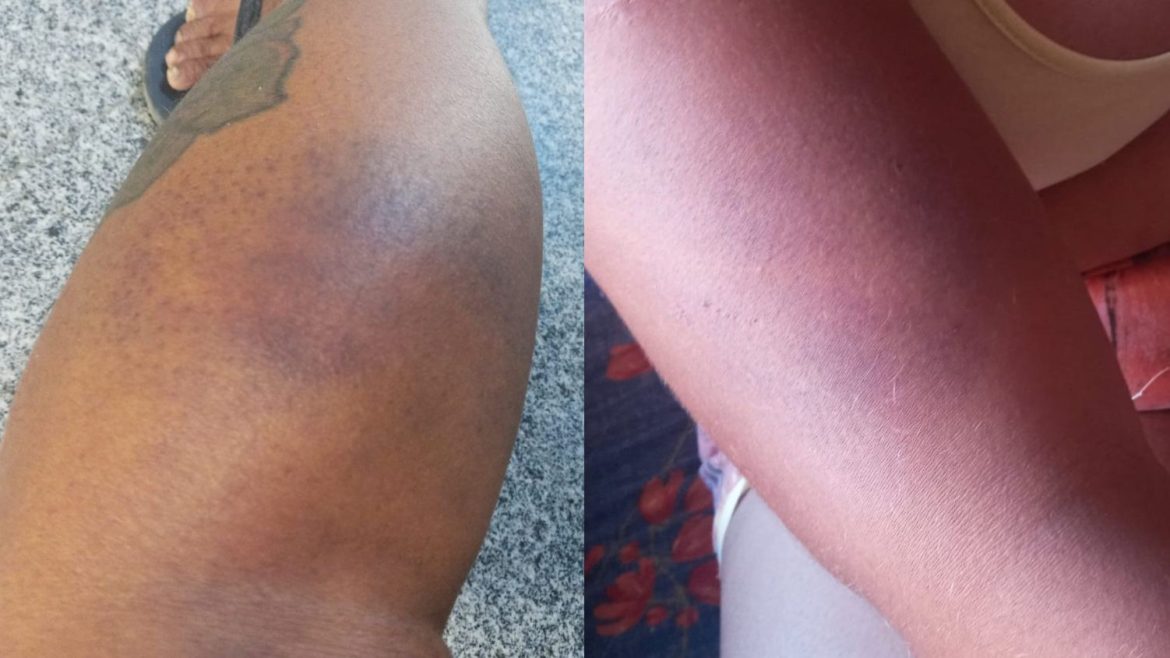 mulheres-agredidas-com-cassetetes-por-pms-ficaram-feridas