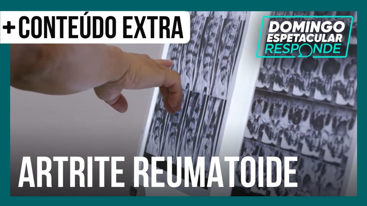 o-que-pode-piorar-a-artrite-reumatoide?-tire-as-duvidas-sobre-a-doenca-|-de-responde