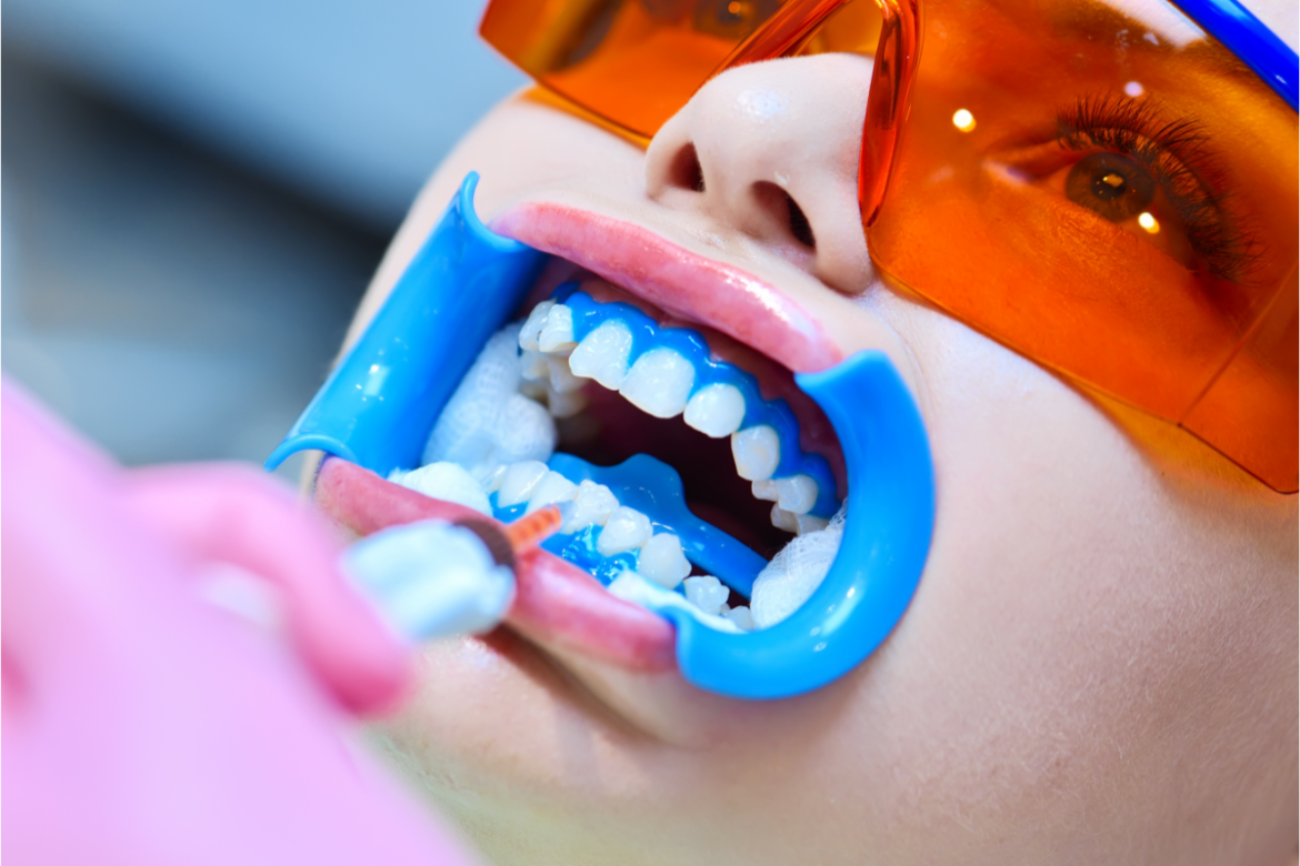 clareamento-dental:-os-mitos-e-verdades-que-voce-precisa-conhecer